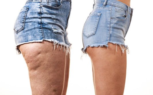 Suction Cups for Cellulite: Do They Really Work? Everything You Need to Know